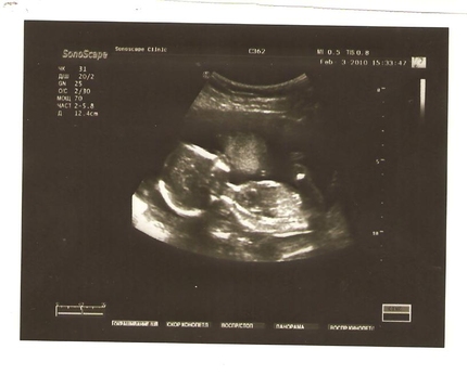 17 недель шевеление плода. УЗИ 17 недель беременности. Снимок УЗИ на 17 неделе беременности. Снимки УЗИ на 17 неделе беременности.