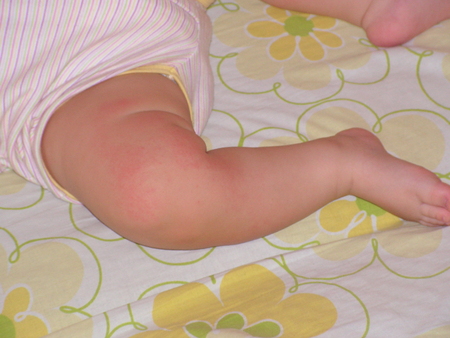 Причины возникновения сухих пятен и шершавости на коже малыша – когда бить тревогу?