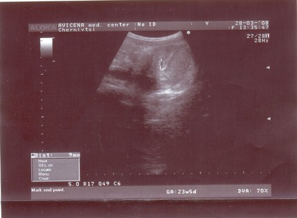 2 Недели Беременности От Зачатия Фото