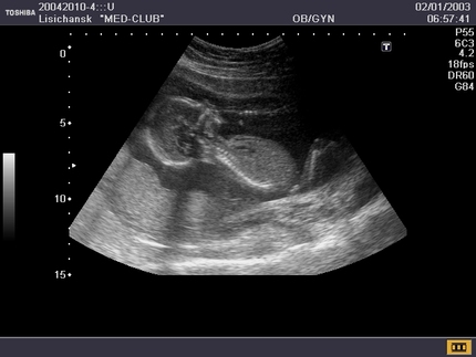 17 недель 2 дня. УЗИ снимок ребенка на 17 неделе. 17 Недель беременности по УЗИ. УЗИ 16-17 недель беременности.