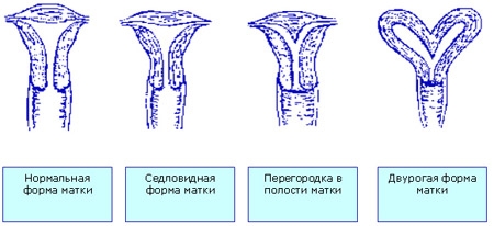 Загиб матки: патология или вариант нормы?