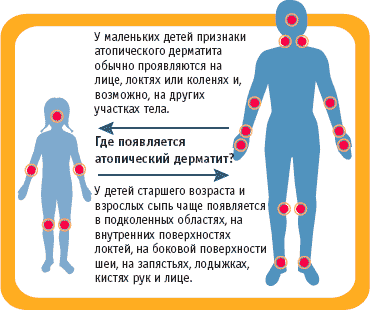 Как избавиться от дерматитов просто и недорого? - steklorez69.ru - Новости Кыргызстана