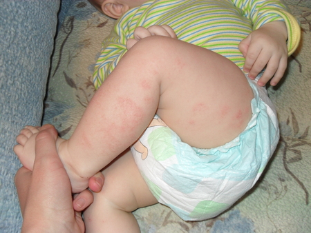 Купание при атопическом дерматите у ребенка