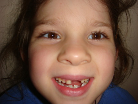 Выпал передний. Выпадение молочных зубов. Дырки на зубах у 3 летнего ребенка. Фото детей с черными передними зубами. Выпал передний.