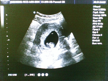 8 неделя беременности: эмбрион, анализы, тянет живот, УЗИ, нормы показателей, выделения