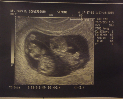 Фото Эмбриона 10 Недель Беременности Узи