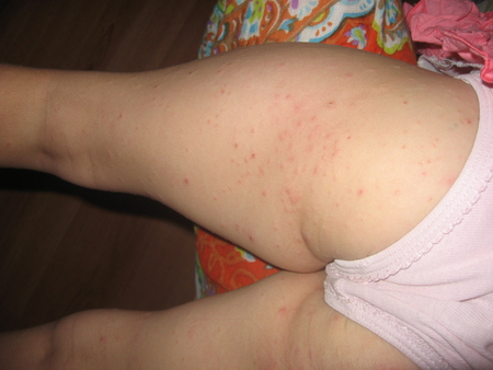 врачи говорили,что это аллергия на сладкое — 13 ответов | форум Babyblog