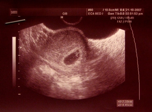 Эмбрион 5 Недель Фото