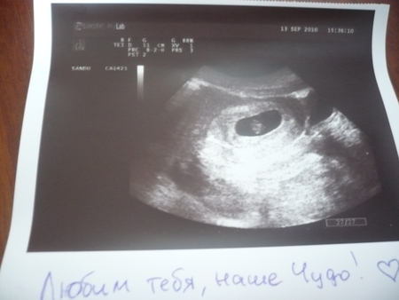 7 недель мальчику. УЗИ 6-7 недель беременности двойня. УЗИ двойняшек на 5 неделе беременности. УЗИ 7-8 недель беременности двойня.