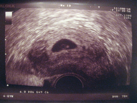 6 недель в россии. Фото эмбриона на 6 неделе беременности на УЗИ. 6 Акушерских недель беременности на УЗИ. 6 Недель беременности фото плода на УЗИ. Фото УЗИ на 6 неделе беременности акушерской.
