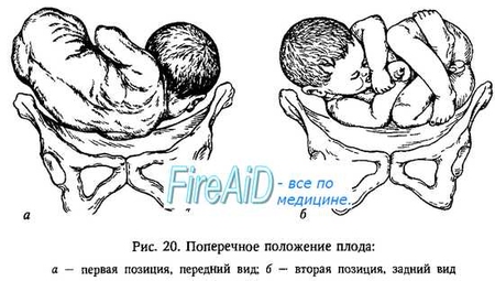 Положение плода картинки