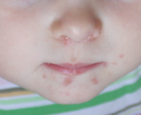 Симптомы и лечение заеды на губах у взрослых и детей