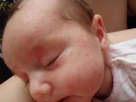 Сыпь у новорожденных: опасные и безопасные высыпания, милии, акне, меланоз и дерматит