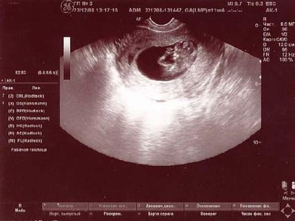 Матка 6 7 недель. УЗИ матки на 7 неделе беременности. Размер матки на 8 неделе беременности УЗИ. Матка 7-8 недель Размеры. УЗИ 6 недель беременности гипертонус.