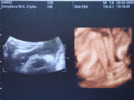 Фото УЗИ на 33 неделе беременности