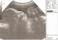 Фото УЗИ на 42 неделе беременности